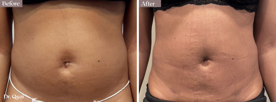 smartlipo abs before after